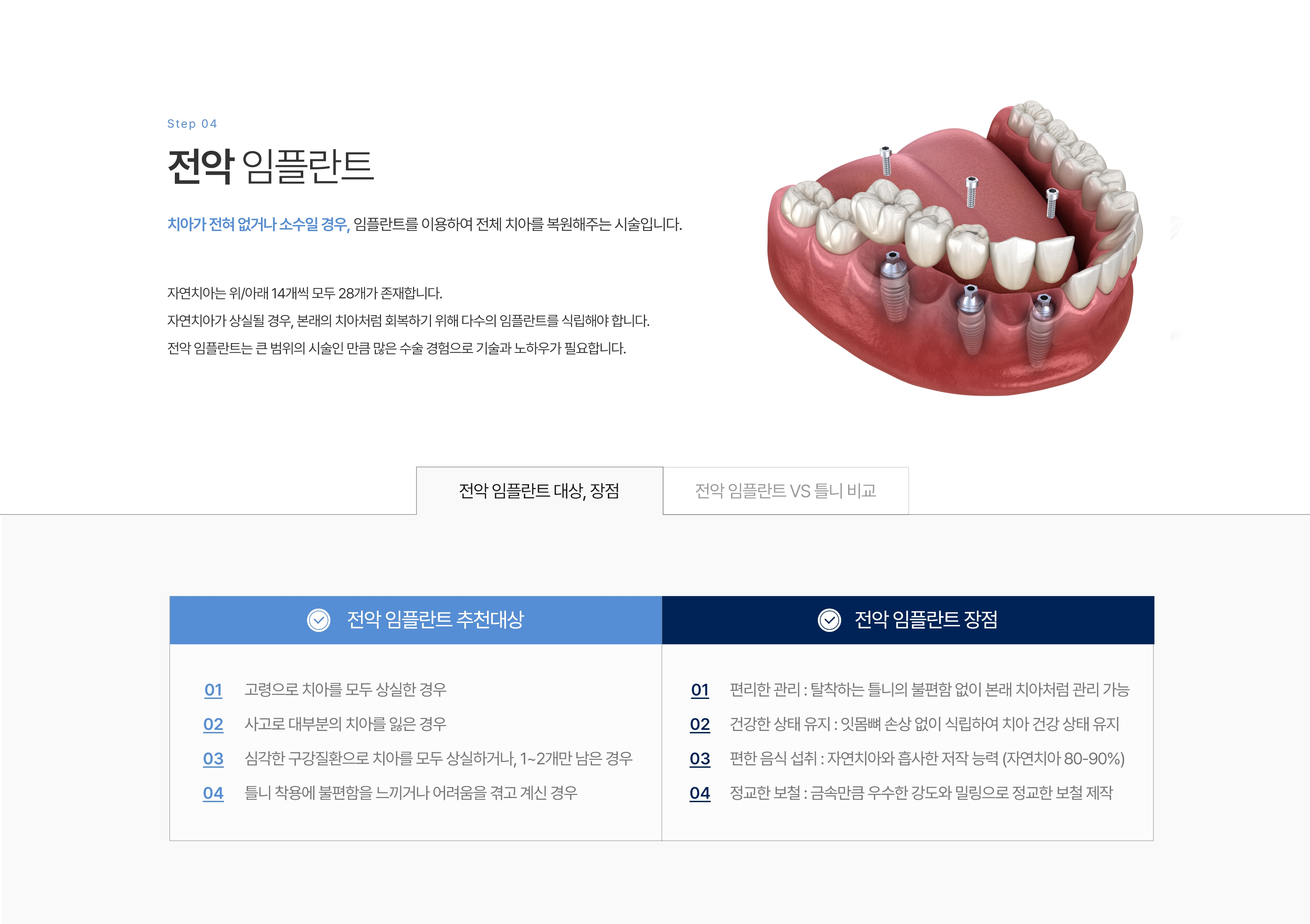 수면 임플란트