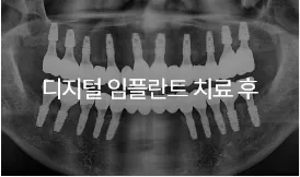 디지털 임플란트 치료 후
