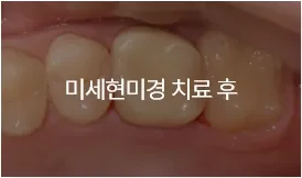 미세현미경 치료 후