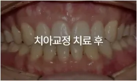 치아교정 치료 후