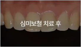심미보철 치료 후