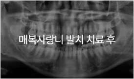 매복사랑니 발치 치료 후